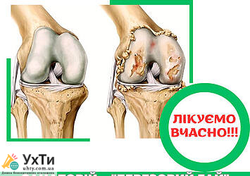 OSTEOARTROZ Дошка оголошень УХТИ