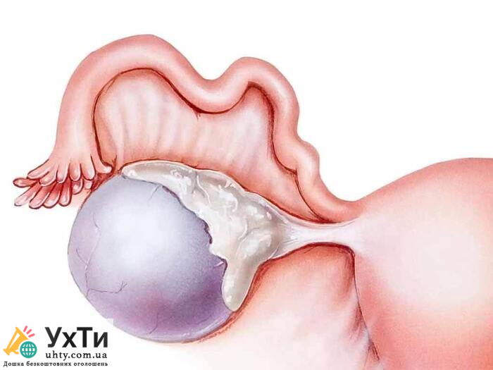 Как быстро растет киста яичника