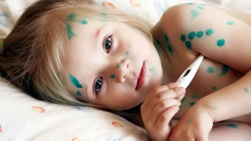 Ветряная оспа: как избежать осложнений с помощью своевременных анализов Объявления УХТЫ | osnov-26424